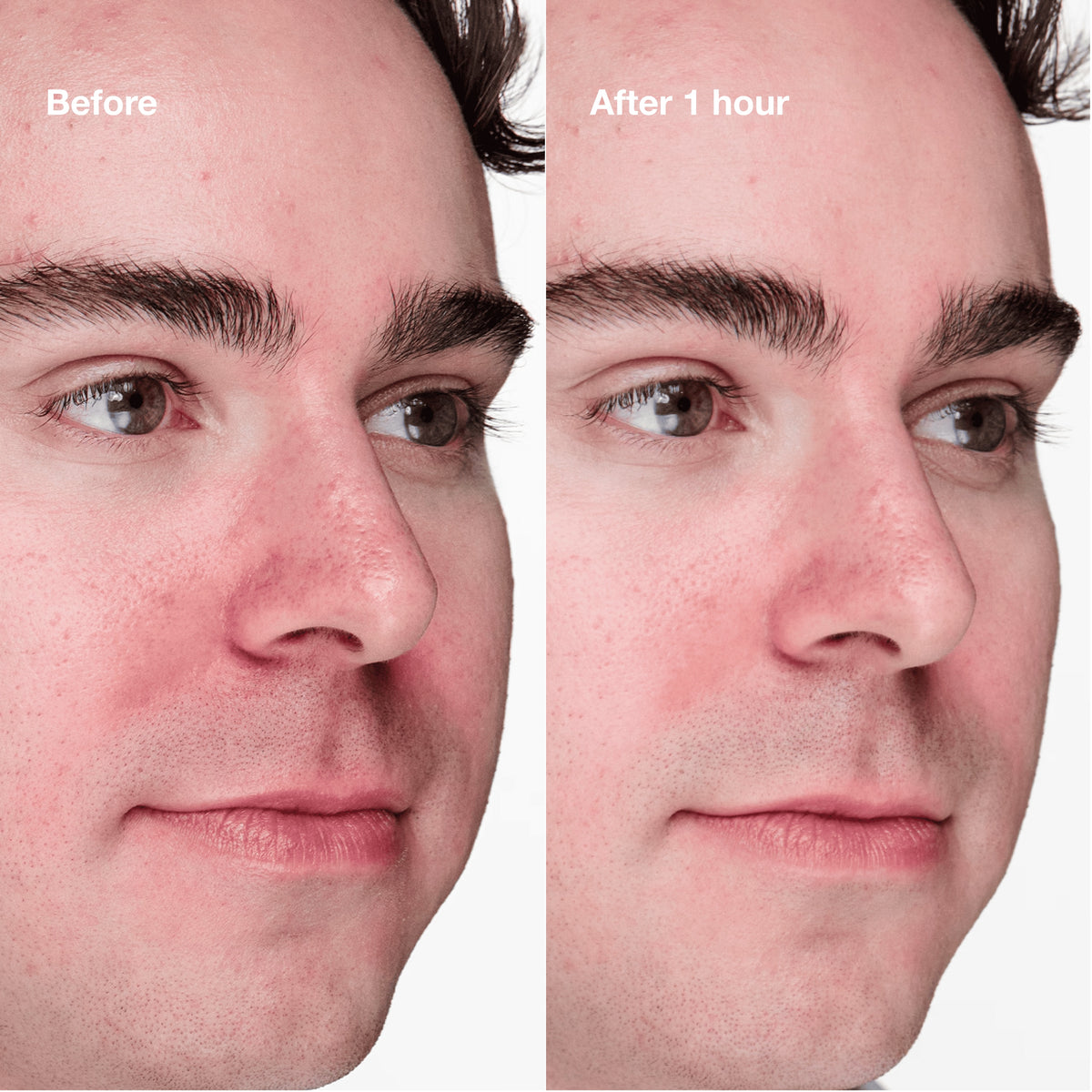 Anti-Blemish Solutions Clinical™ Advanced Clearing Gel 2% Salicylic Acid