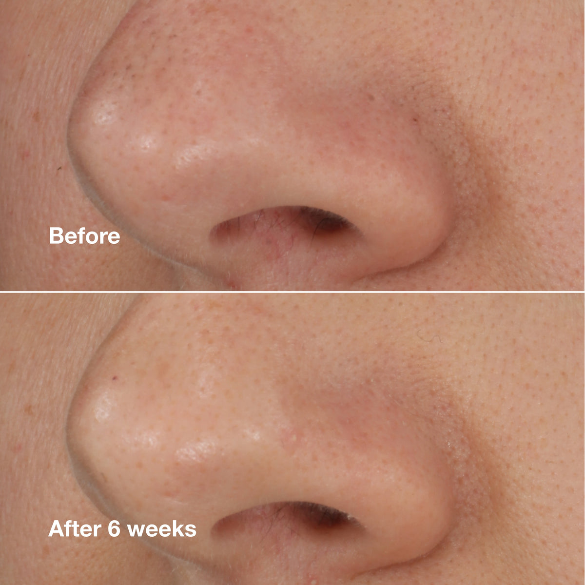 Blackhead Solutions Self-Heating Blackhead Extractor