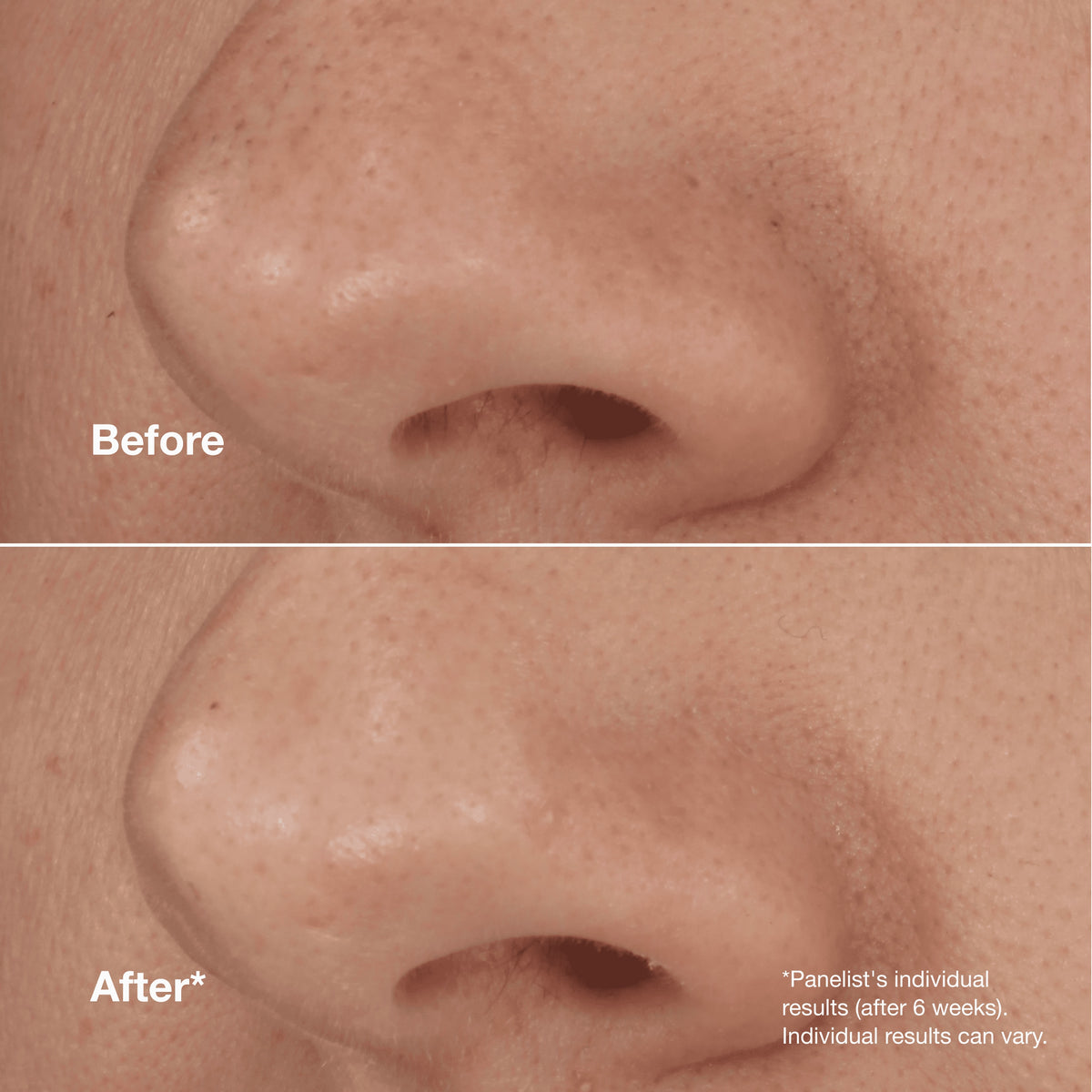 Blackhead Solutions Self-Heating Blackhead Extractor